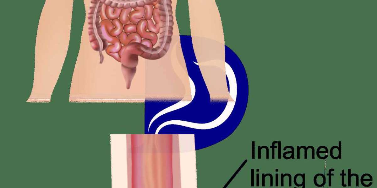Barrett's Esophagus Treatment: Options and Outcomes